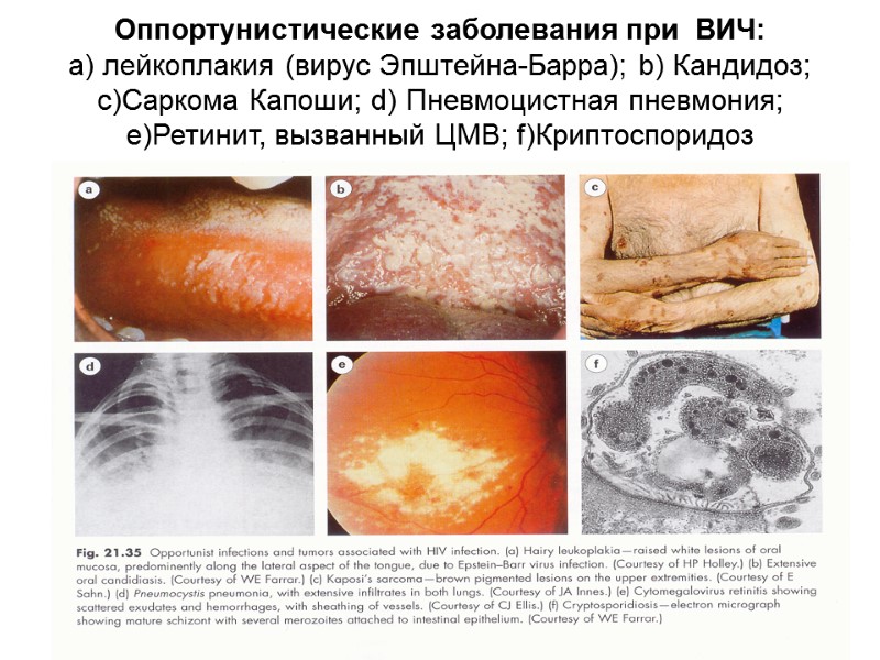 Оппортунистические заболевания при  ВИЧ:  а) лейкоплакия (вирус Эпштейна-Барра); b) Кандидоз; c)Cаркома Капоши;